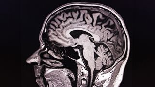 Seitlicher schwarz-weißer MRT-Scan eines menschlichen Gehirns und Schädels.